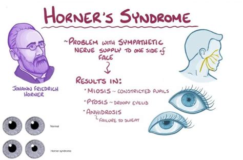 Horner Syndrome Symptoms Causes Treatment OBN