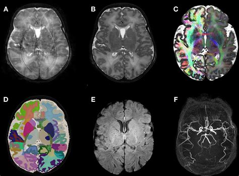 Advances In Neonatal Mri Of The Brain From Research To Practice Adc