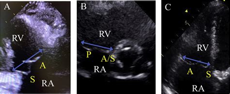 Characteristics And Significance Of Tricuspid Valve Prolapse In A Large