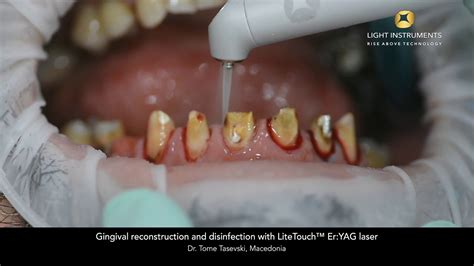 Gingival Reconstruction And Disinfection With Litetouch™ Eryag Laser