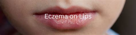 Eczema On Lips