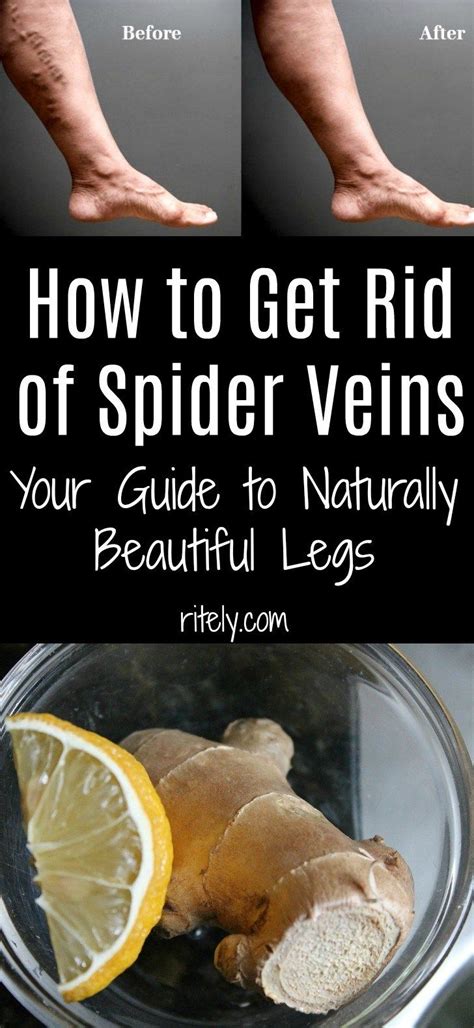 How To Get Rid Of Spider Veins On Legs