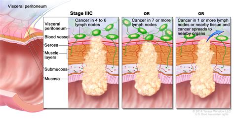 Signs And Symptoms Of Stage 4 Colon Cancer Understand How Colorectal Cancer Is Staged And