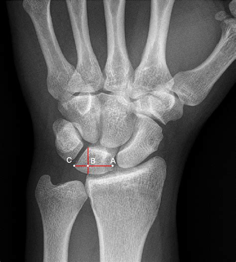 Perilunate Dislocations And Fracture Dislocations Journal Of Hand Surgery