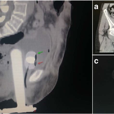 A Sagittal View Of The Fused Planning Ct Scan At Both Tension Levels
