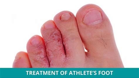 Home Remedies For Athletes Foot