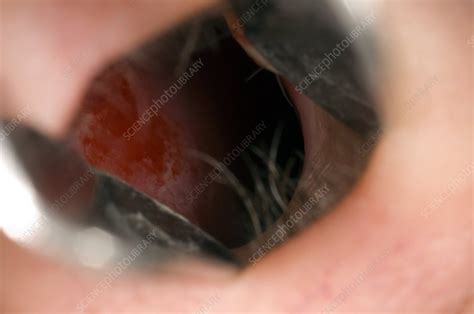 Inflamed Mucosa In The Nose Stock Image C0029599 Science Photo