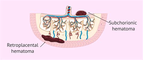 Intrauterine Hematomas In Pregnancy Their Cause And Treatment