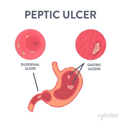 Peptic Ulcer Stomach Disease Infographic Poster Endoscopic Image Posters For The Wall Posters