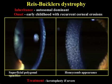 17 Corneal Dystrophies