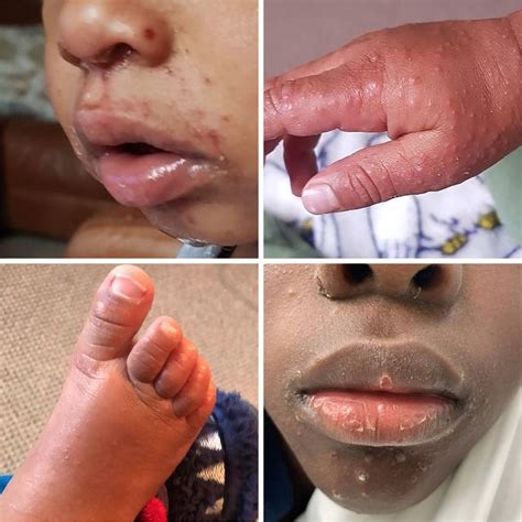 hand foot and mouth disease adults face