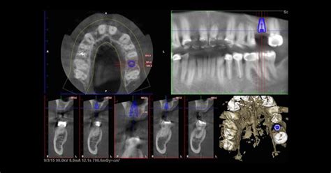 Implant Scenario Infected Tooth Mint Hill Dentistry