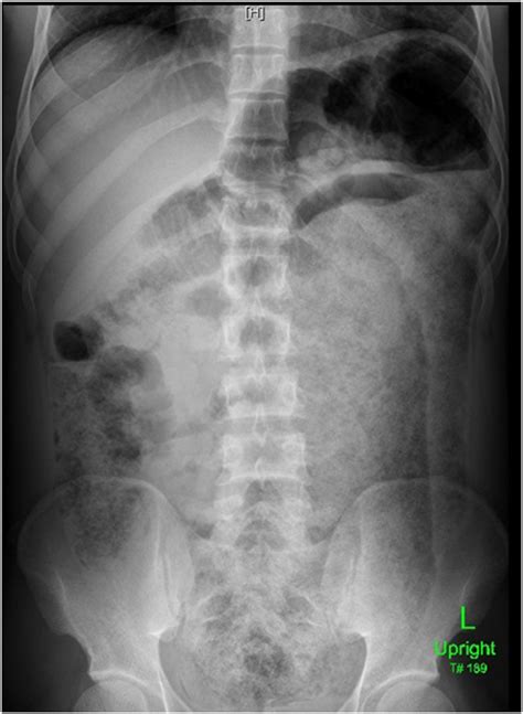 It is of no help in the diagnosis of acute appendicitis or certain other acute conditions such as ruptured ectopic pregnancy. Plain erect abdominal X-ray showing huge fecal loading of ...