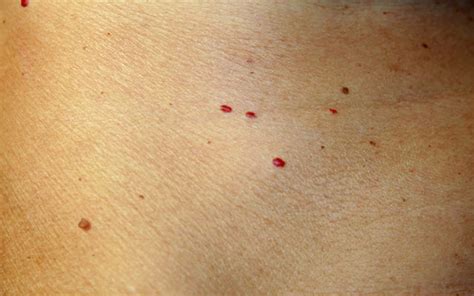 Red Spots On Skin Causes Treatment And When To Worry