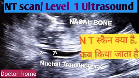 Nt Scan Level 1 Ultrasound Pregnancy Ultrasound Doctor Home Youtube