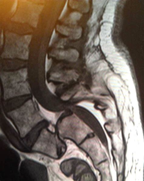 Bulging Disc Lumbar Spine Mri