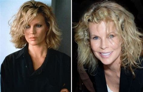 Kim Basinger Before And After Plastic Surgery