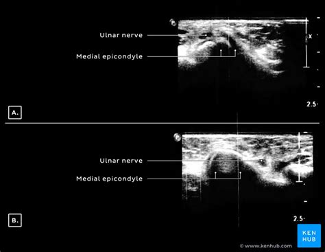 Ulnar Nerve Subluxation Clinical Anatomy Kenhub