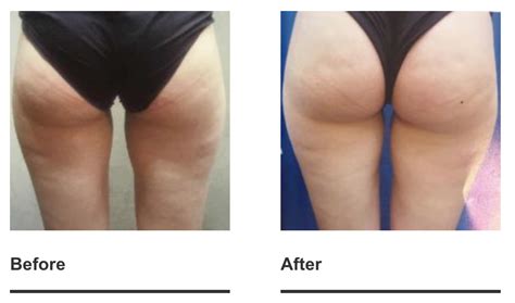 cellulite reduction your health district