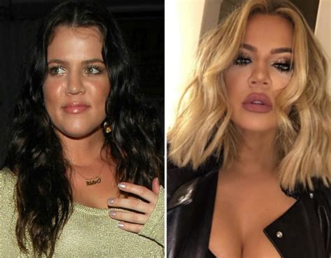 Khloé Kardashian Face Filler Transformation Buzzpopdaily