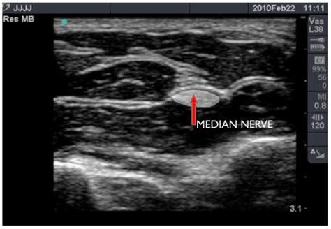 Ultrasound Guided Local Anaesthetic Blocks Of The Forearm Wfsa