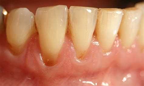 Zahnfleischaufbau Und Bindegewebstransplantation