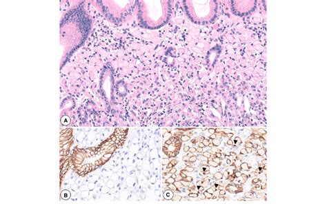 A A Typical Signet Ring Cell Carcinoma Focus From A Cdh1 Carrier B
