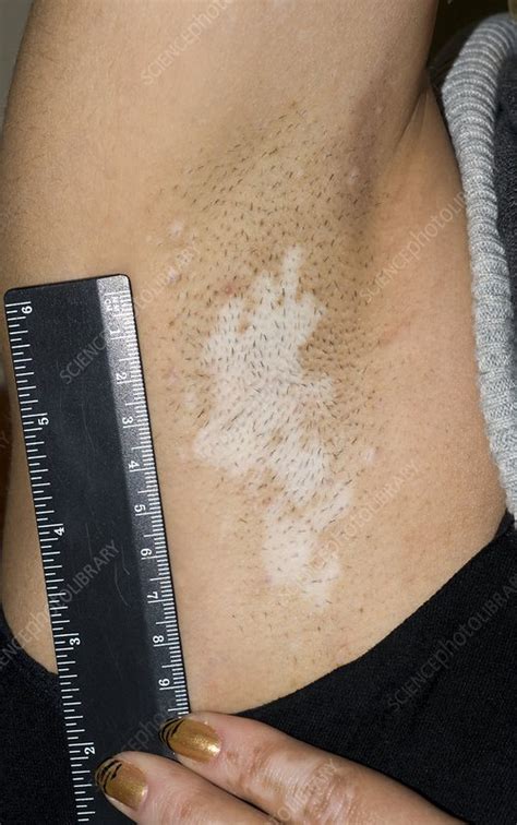 Vitiligo Of The Underarm Stock Image C0018637 Science Photo Library