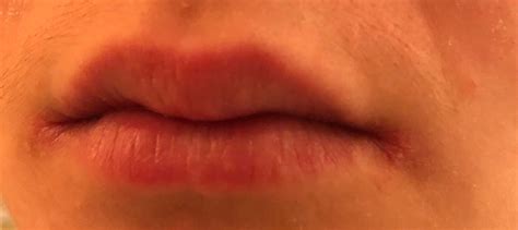 Skin Concerns Help On Ridding Myself With This Lip Corner Gunk