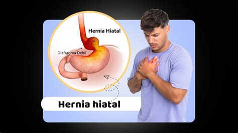 Hernia Hiatal ¿qué Es Síntomas Tratamiento Tipos