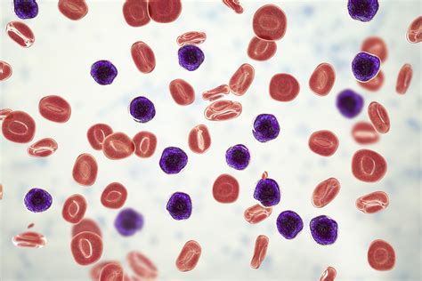 Blood Cancers Types Diagnosis Prognosis