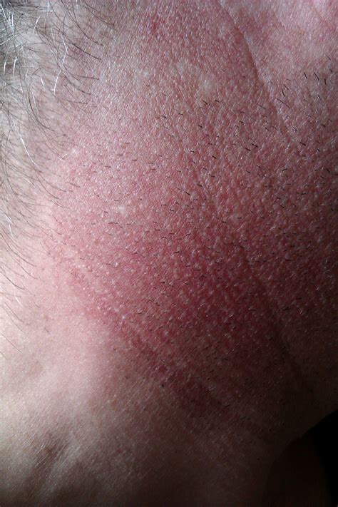 Hi I Have A Red Rash Just Below My Ears With Some White Marks