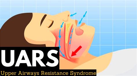 Upper Airway Resistance Syndrome UARS YouTube