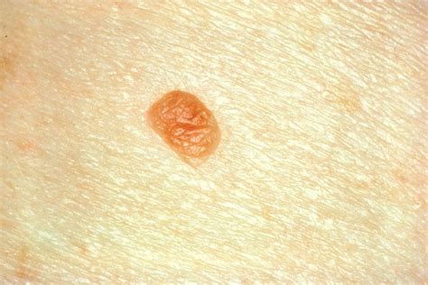 Spot The Differences Between A Mole And Skin Cancer