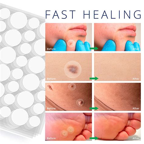 Skin Tag Remover Patches New And Improved Formula Skin Tag Removal