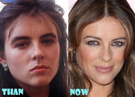 Elizabeth Hurley Plastic Surgery Before And After Photos Lovely Surgery