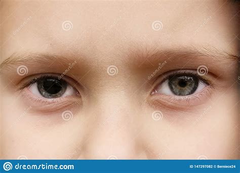 Anisocoria Stock Photo Image Of Ophthalmologist Exotropia 147297082