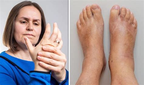 Arthritis ‘swollen Sausage Like Toes Could Be A Symptom Of Psoriatic
