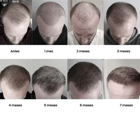 Update 71 One Month After Hair Transplant Super Hot In Eteachers