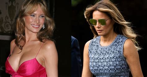 Melania Trump Denies Plastic Surgery Breasts Before And After