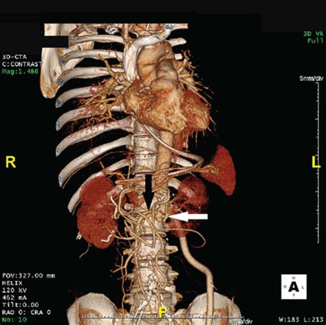 Postoperative Three Dimensional Reconstructed Computed Tomography Scan