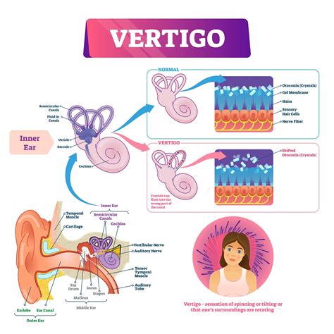 Vertigo Vector Illustration Labeled Medical Vestibular Ear Prob The