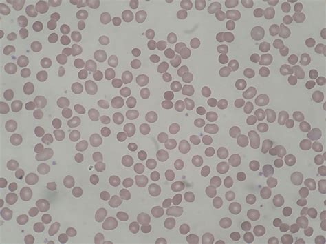 Although relatively rare, hereditary spherocytosis (hs) is the most common cause of hemolytic anemia due to a red cell membrane defect. File:Hereditary Spherocytosis smear 2010-03-17.JPG - Wikimedia Commons