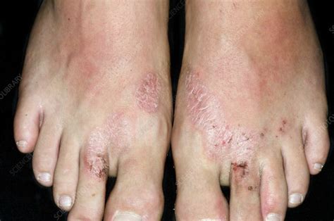 Red Feet Foot Redness Symptoms Causes And Treatment