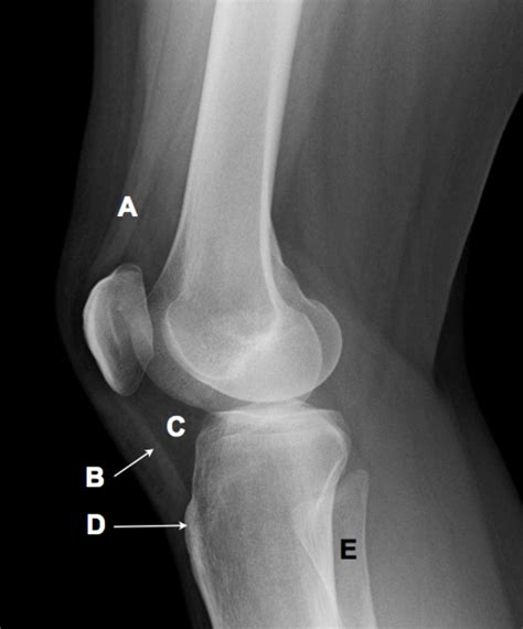 Knee Radiograph An Approach Radiology Reference Artic Vrogue Co