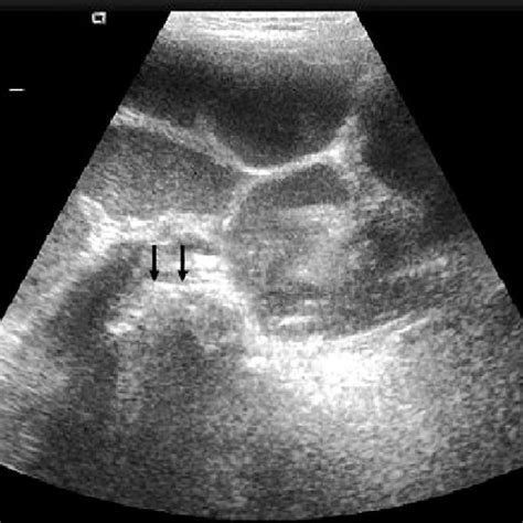 An Abdominal Ultrasound Revealed Diffuse Dilated Bowel Loops And An