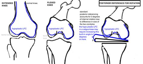 Tka For Valgus Deformity — Hip And Knee Book