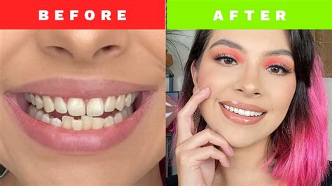 Invisalign Treatment Before And After My Journey Youtube
