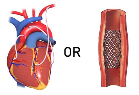 Angioplasty Vs Heart Bypass Surgery How The Doctor Decides Masina