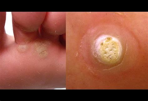 Foot Diseases And Disorders Pictures